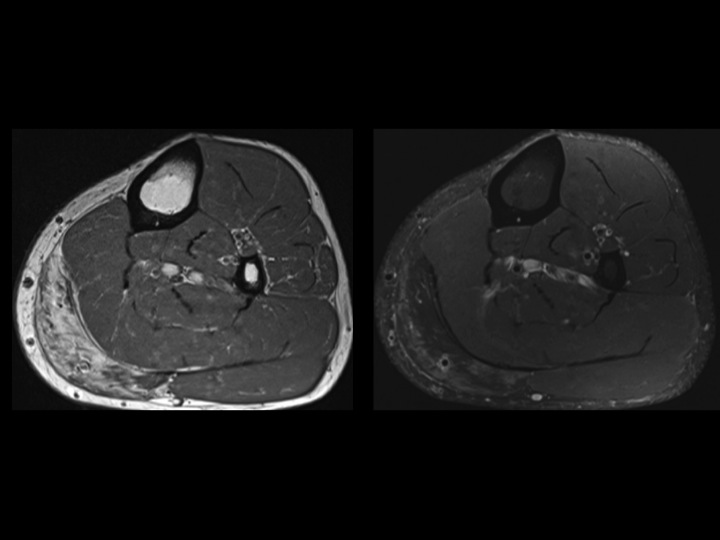 Figure 2 for case soleus muscle ( RID2924 )